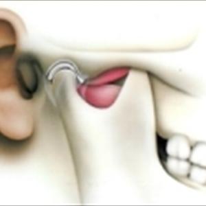 Moderate Tinnitus Idmetakeywords - Tinnitus Hypnosis - A Proven Treatment For Tinnitus